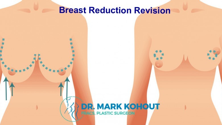 Breast Lift And Implants Sydney