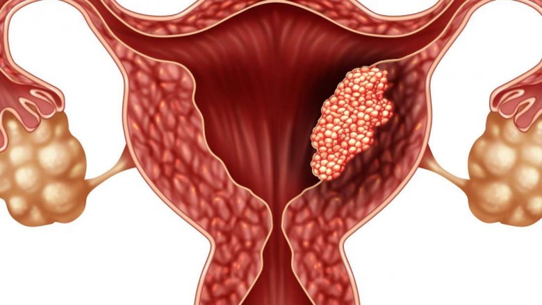 FDA Grants Accelerated Approval to Jemperli as Uterine Cancer Drug for Recurrent or Advanced Stage Endometrial Cancer