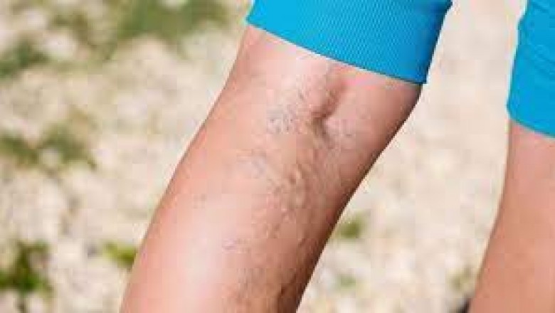 Five Things You Should Know About Varicose Vein Treatment Cost