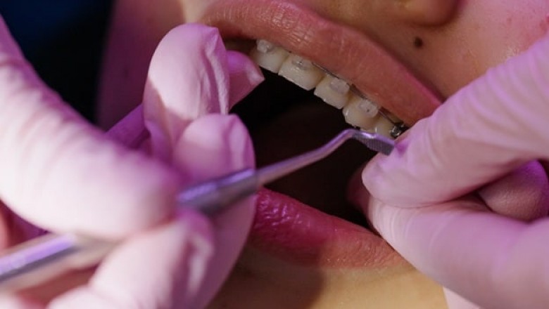 Important Facts Behind The Of Invisalign Braces