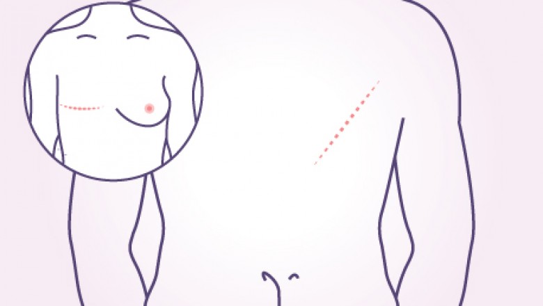 Latissimus dorsi(LD) flap reconstruction | Dr. Deepak Jha