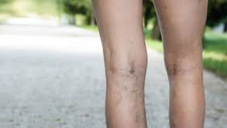 Lindenhurst Veins Treatment Near Me