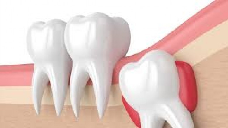 Pros And Cons Of Wisdom Teeth Removal: