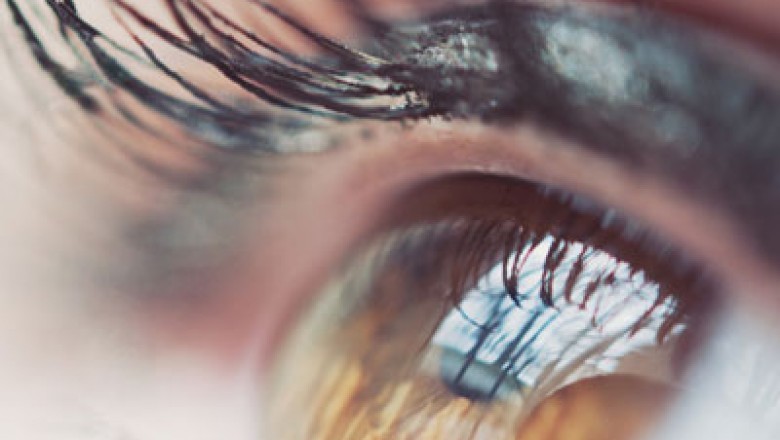Glaucoma Therapeutics include, laser trabeculoplasty and eye drops