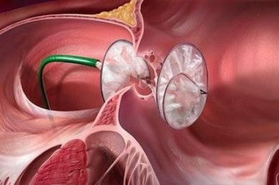 PFO Closure Devices Market Size, Trends, Shares, Insights and Forecast – 2018-2026