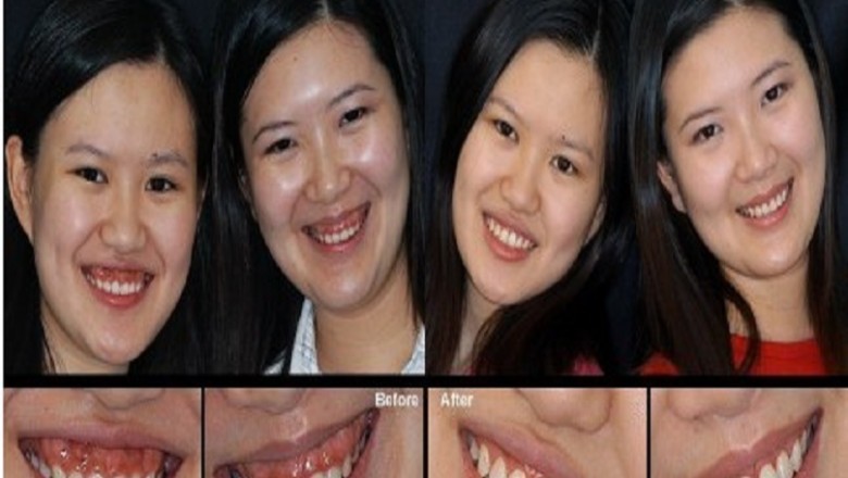Teeth Under Veneers