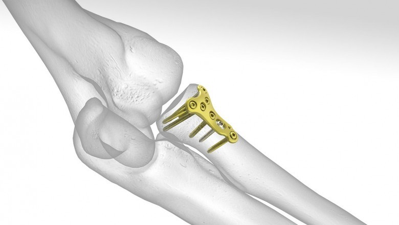 Radial Head Resection Implants; Recommended for Type III and Type IV Radial Head Fractures