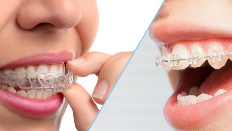 Best Invisalign Dentist Near Me