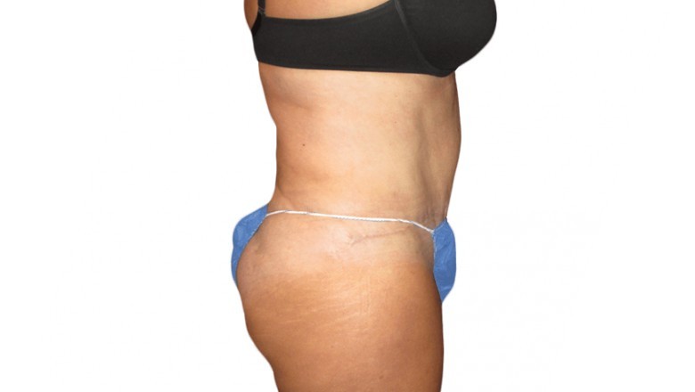 How Does Breast Lift And Reduction Surgery Will Help You?
