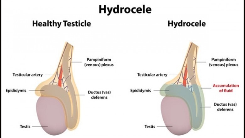 How does hydrocele affect infants and adults?