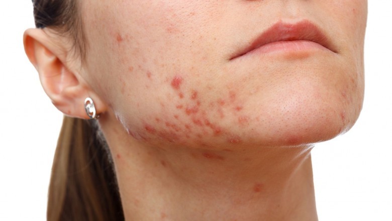 Acne Treatment Near Me - Medicine For Acne Vulgaris