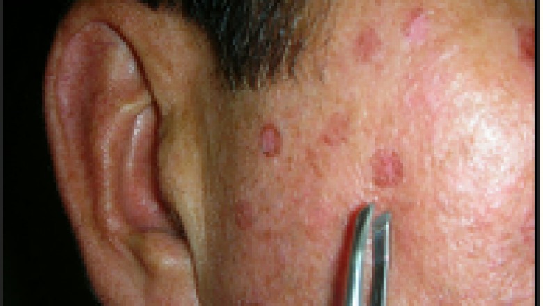 What to know about skin Blemishes and professional blemish removal product?