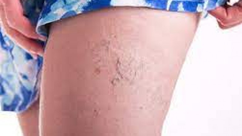 How Vein Treatment Can Better Your Life?