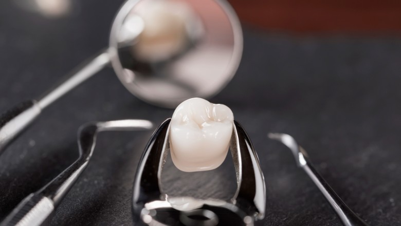 What are Dental Veneers and their Procedure?