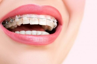 BRACES and Youngsters ORTHODONTICS | Luminous Dental Group