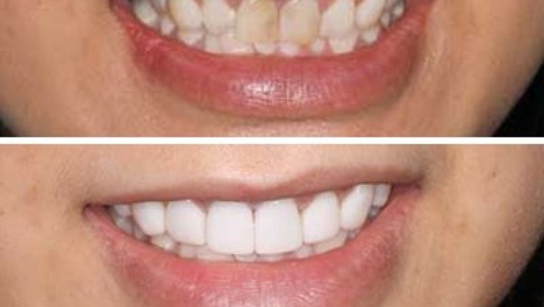 Porcelain Veneers Cost Manhattan