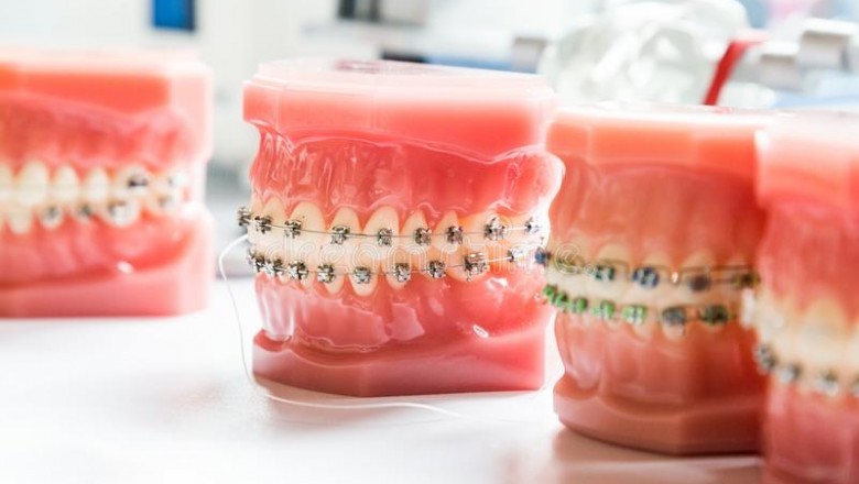 Why Impacted Wisdom Teeth Removal is Necessary?