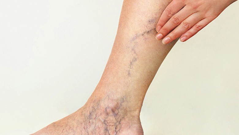 3 Vein Treatment You Probably Want To Try