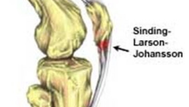 Sinding Larsen Johansson Syndrome