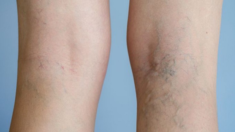 Is A Nutritious Diet Effective To Deal With Varicose Veins?