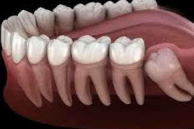 Periodontitis: What Are The Different Stages?