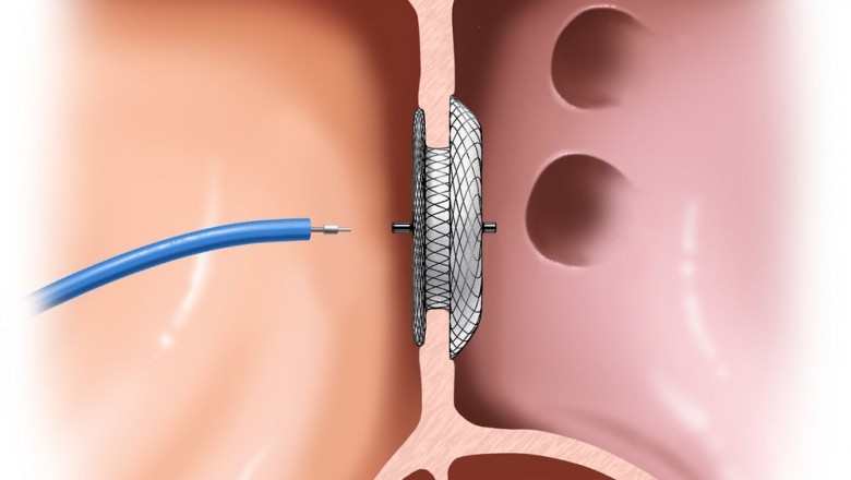 Who are the top players that are involved in manufacture of Patent Foramen Ovale (PFO) Closure Devices Market ?