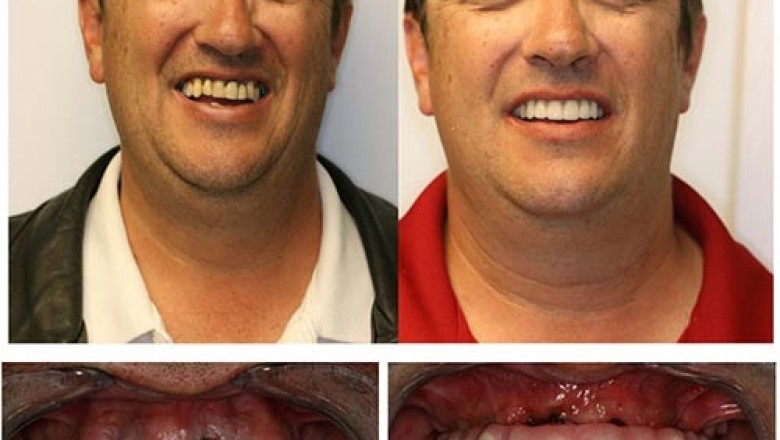 beylikdüzü implant