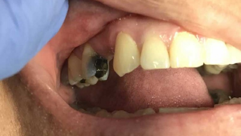 Impacted Wisdom Teeth Extraction: Why Is It necessary?