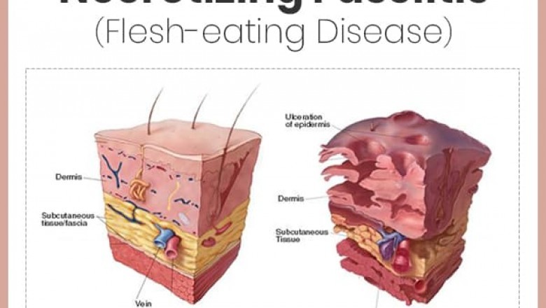 Necrotizing Fasciitis Market 2021-2028 Know About Growth Rate, Trends, Segmentation and Key Players WOCKHARDT, Atox Bio, Teva
