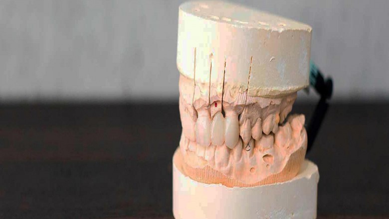 Reasons For Removing Wisdom Teeth!
