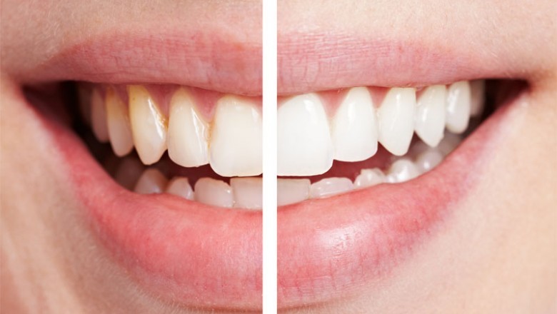 What are Types Of Porcelain Veneers