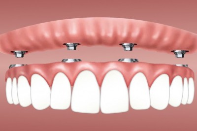 Dental Veneers; What To Know About Them?