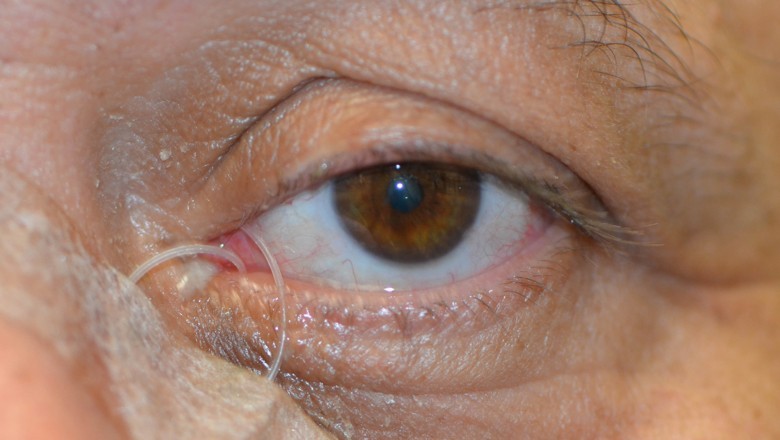 Nasal Lacrimal Stents are stents that are inserted into the lacrimal system of the nose to keep it open.