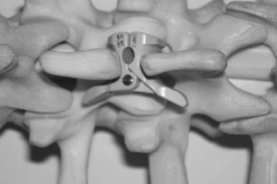 Seven Latest Developments In Interspinous Process Decompression Devices.