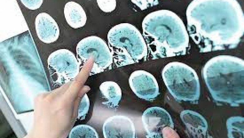 Acute Ischemic Stroke Therapeutics; After Stroke Symptoms Begin, a tPA Injection Can Be Given