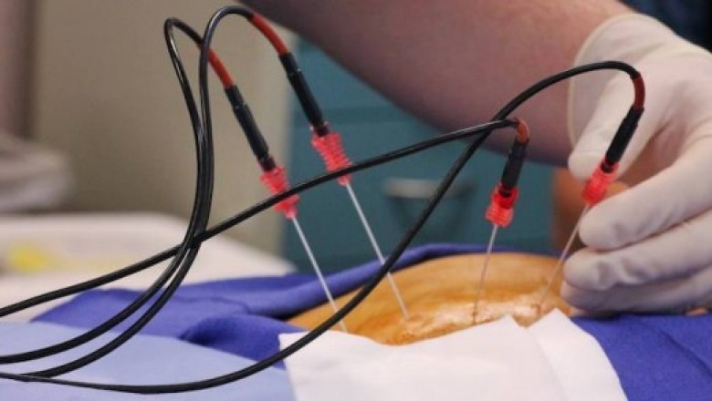 Growing Industry of Ablation Technology Market 2021-2028 | Estimated to Reach High CAGR | Top Key Players – Medtronic, Olympus, Smith & Nephew