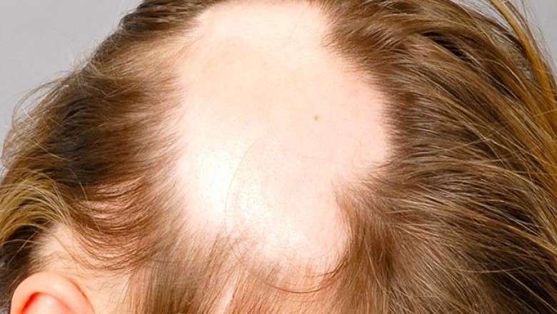 The approval of novel drugs and presence of a robust pipeline are expected to drive global alopecia treatment market growth.