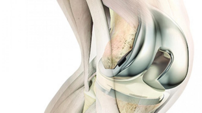 Growth of the knee implant market is expected to be supported by increasing prevalence of arthritis and obesity