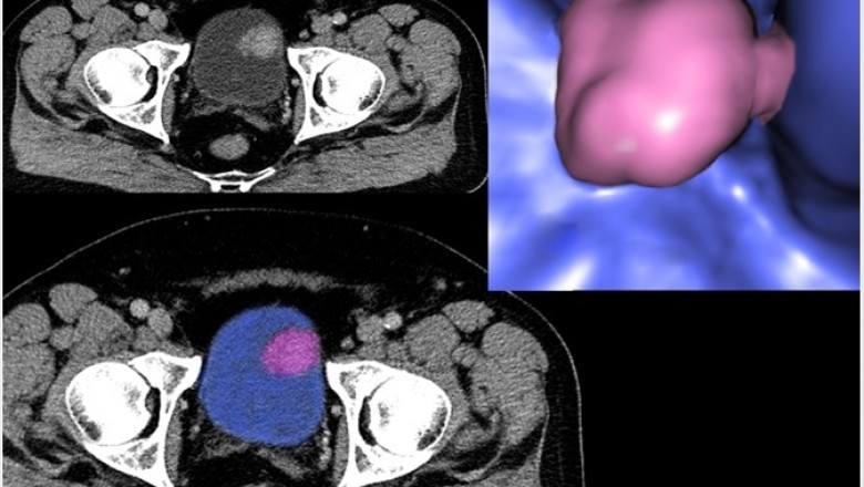 Non-Invasive Cancer Diagnostics are witnessing wider adoption across the globe