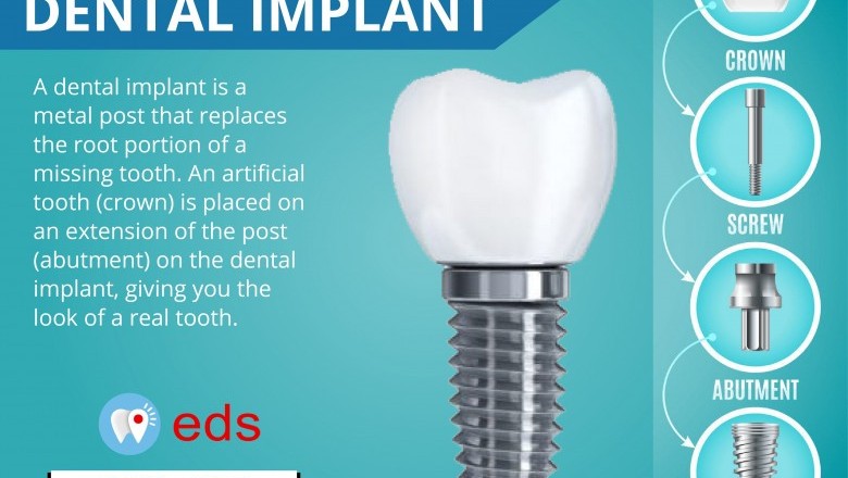Structure of Dental Implant | Emergency Dental Services