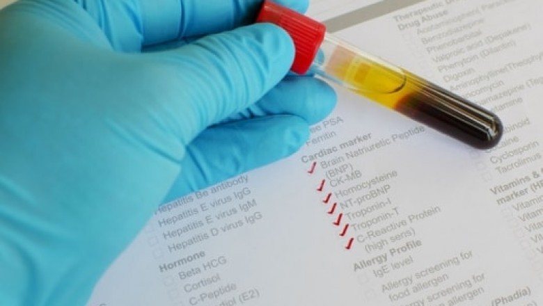 Cardiac Marker Testing Market 2021 Industry Outlook, Business Strategies, Trends and Forecast to 2028