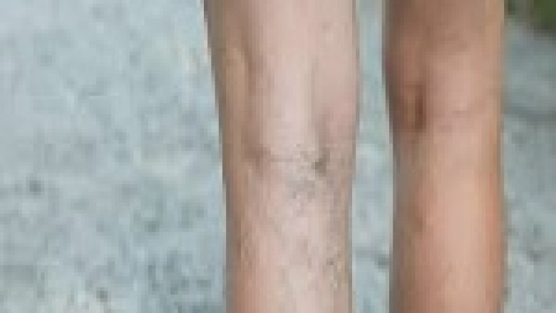 Manhattan Varicose Vein Treatment Near Me.