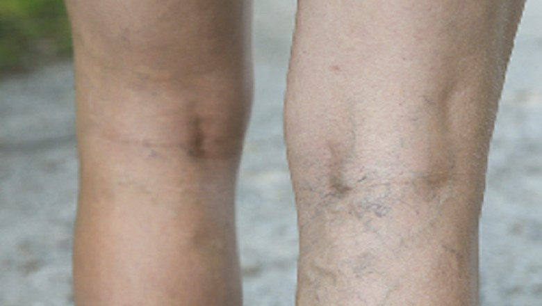 Massage Therapy: An Effective Solution For Frozen Shoulder?