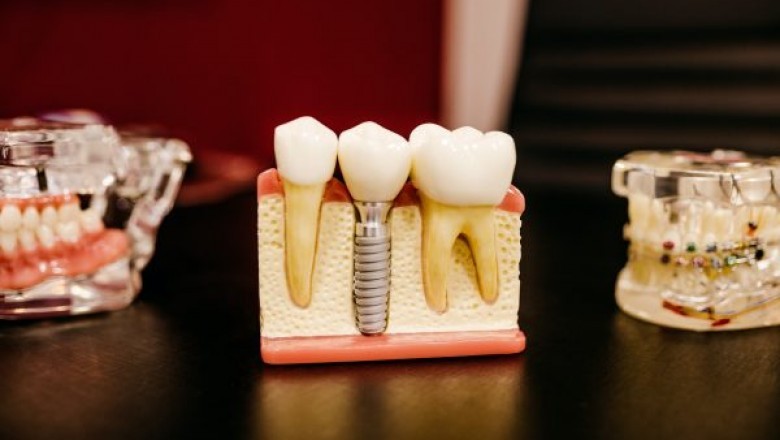 Best Dental Implants Houston
