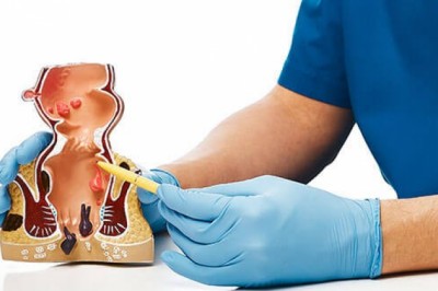 Piles Doctor Bangalore