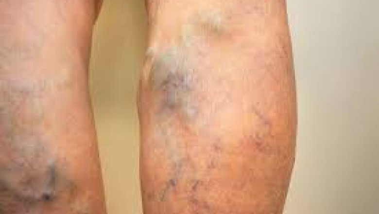How to get relief from painful swollen veins?