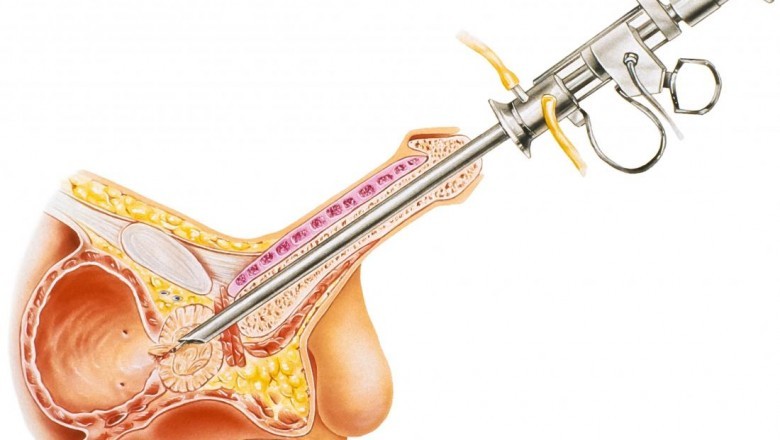 Benign prostate hyperplasia (BPH) refers to the non-cancerous enlargement of prostate