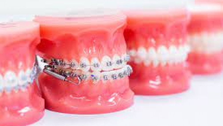 What You Should Know About Dental Implants Procedure?