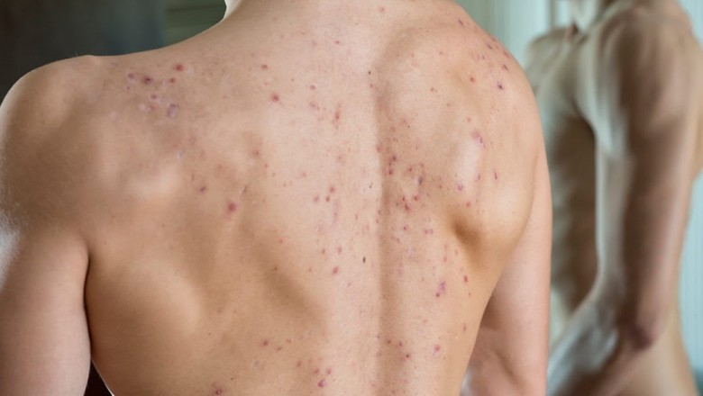 7 Hacks To Get Rid Of Back Acne Naturally!
