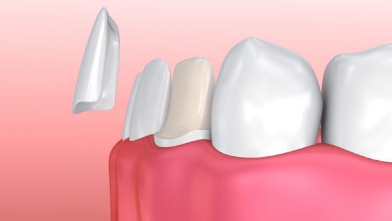Dental Veneers - An Overview